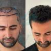 Le 10 Migliori Cliniche per il trapianto di capelli in Turchia: quanto costano 3000 bulbi a Istanbul