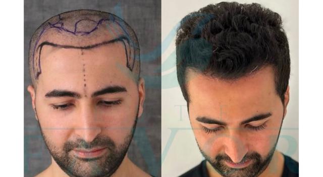Le 10 Migliori Cliniche per il trapianto di capelli in Turchia: quanto costano 3000 bulbi a Istanbul